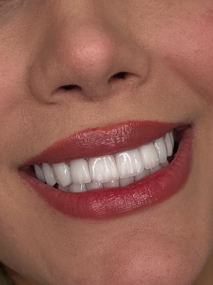 Porcelain veneers, after treatment