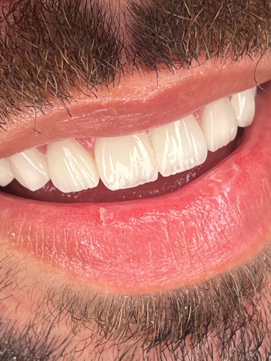 Porcelain veneers case 10, after treatment