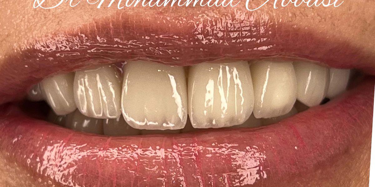 Porcelain veneers case 12, after treatment
