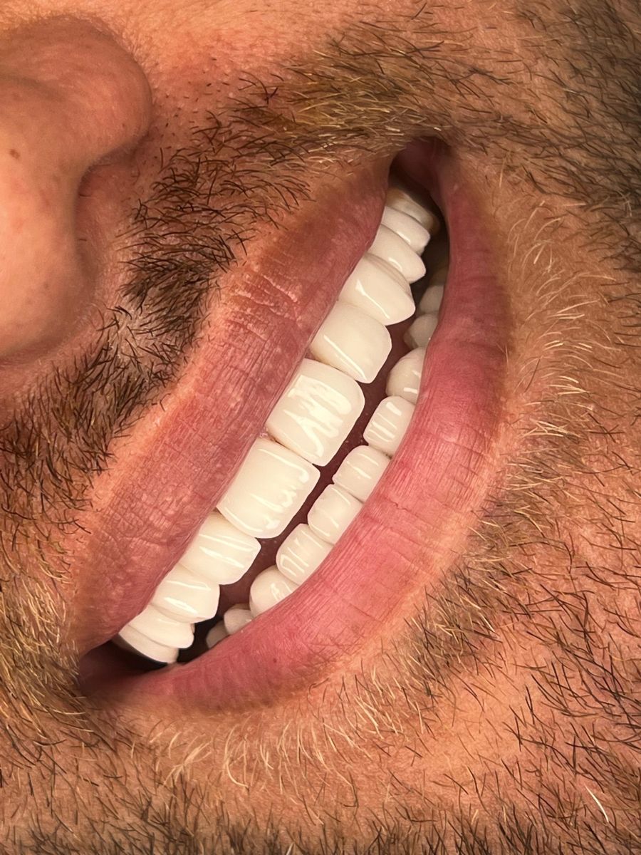 Porcelain veneers, after treatment