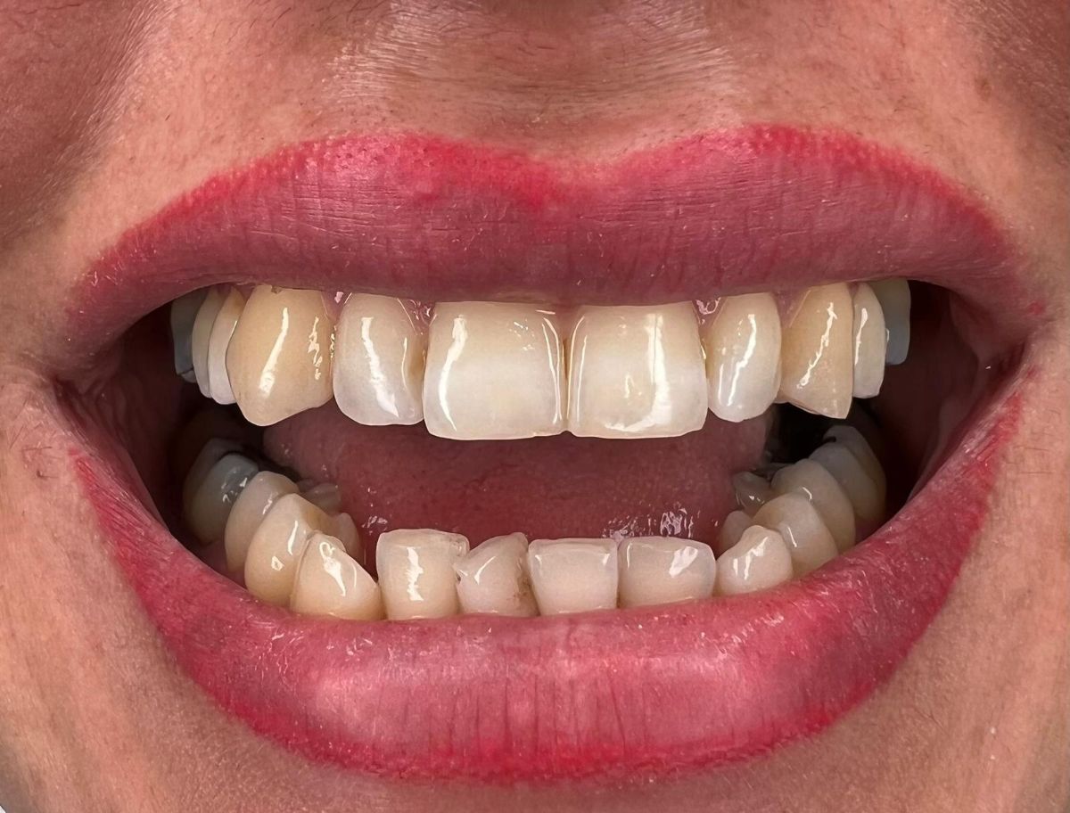 Porcelain veneers, before treatment