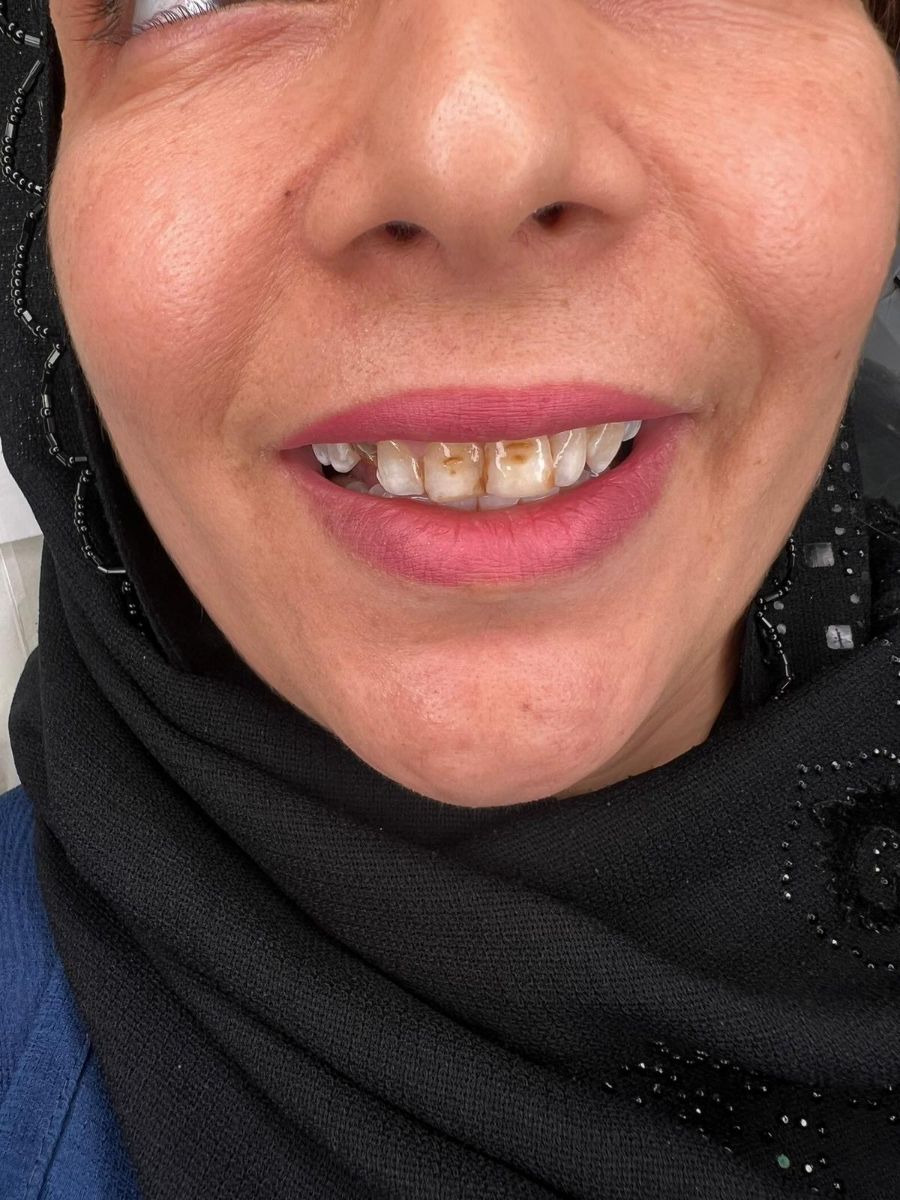 Porcelain veneers case 5, before treatment