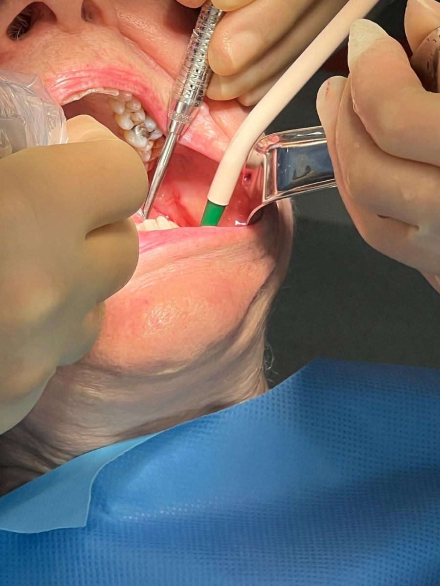 Dental implant case 1, stage 1 of 4